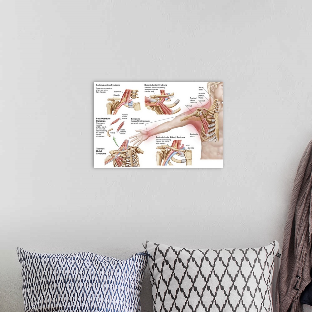 A bohemian room featuring Medical illustration detailing thoracic outlet syndrome.