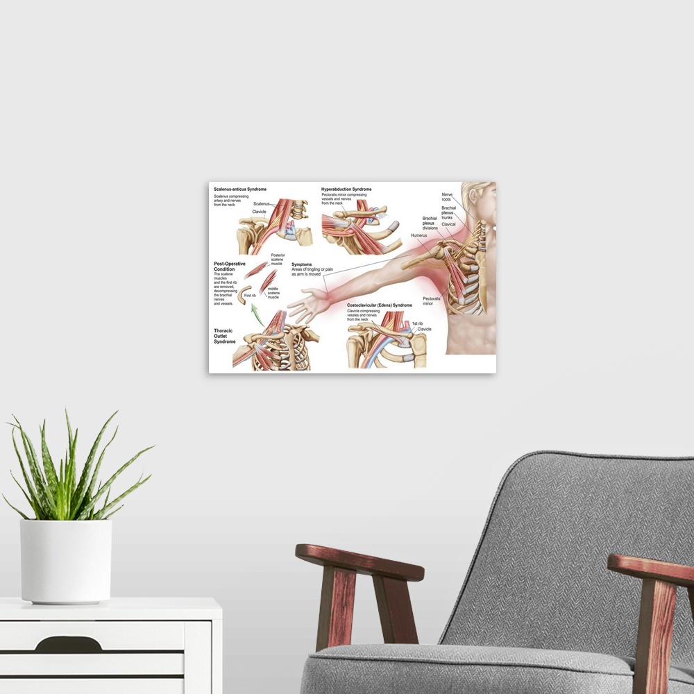 A modern room featuring Medical illustration detailing thoracic outlet syndrome.