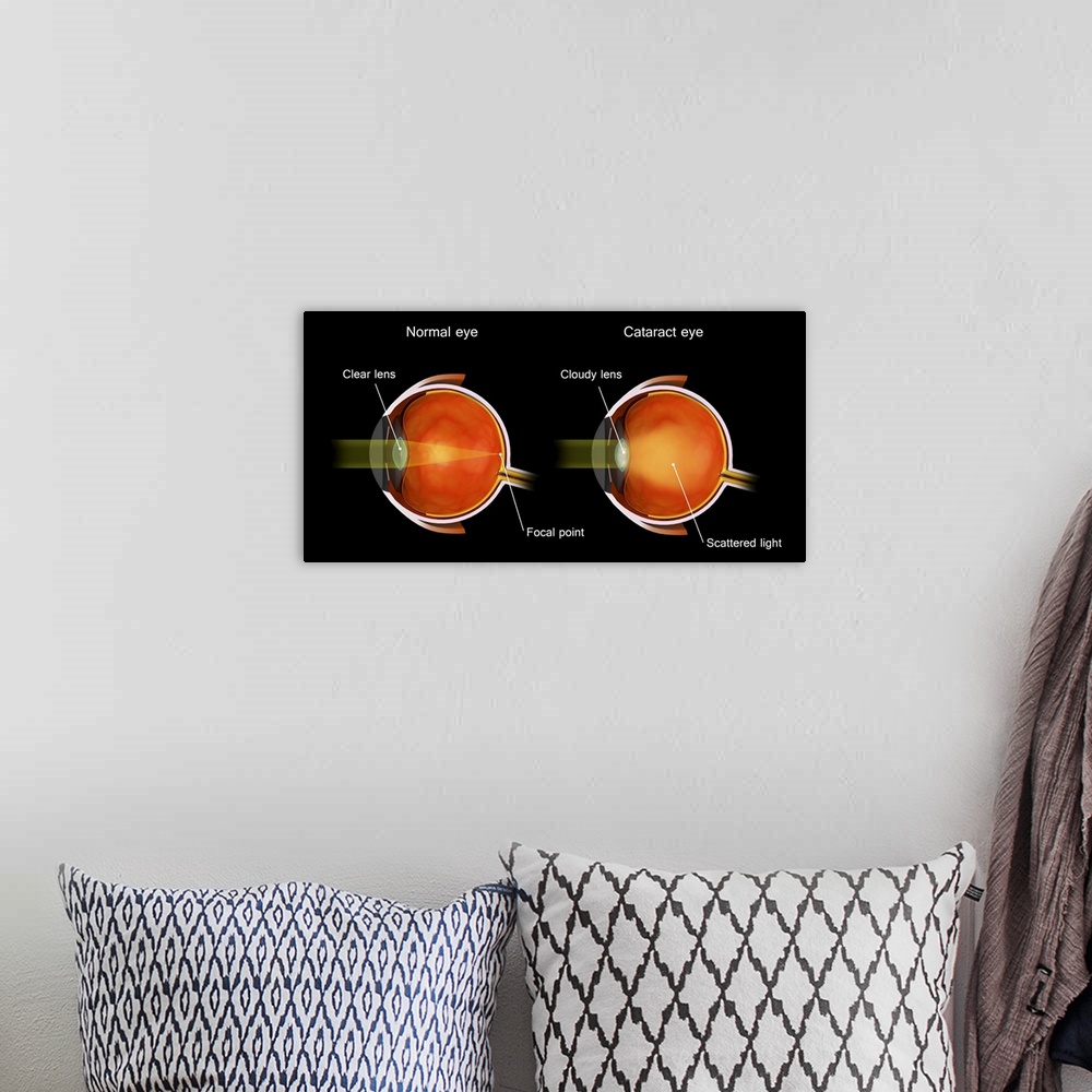 A bohemian room featuring Medical illustration of a cataract in the human eye, compared to a normal eye.