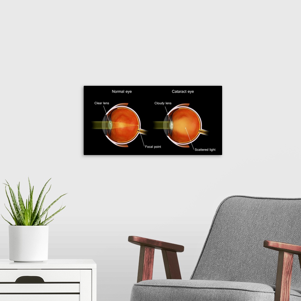 A modern room featuring Medical illustration of a cataract in the human eye, compared to a normal eye.