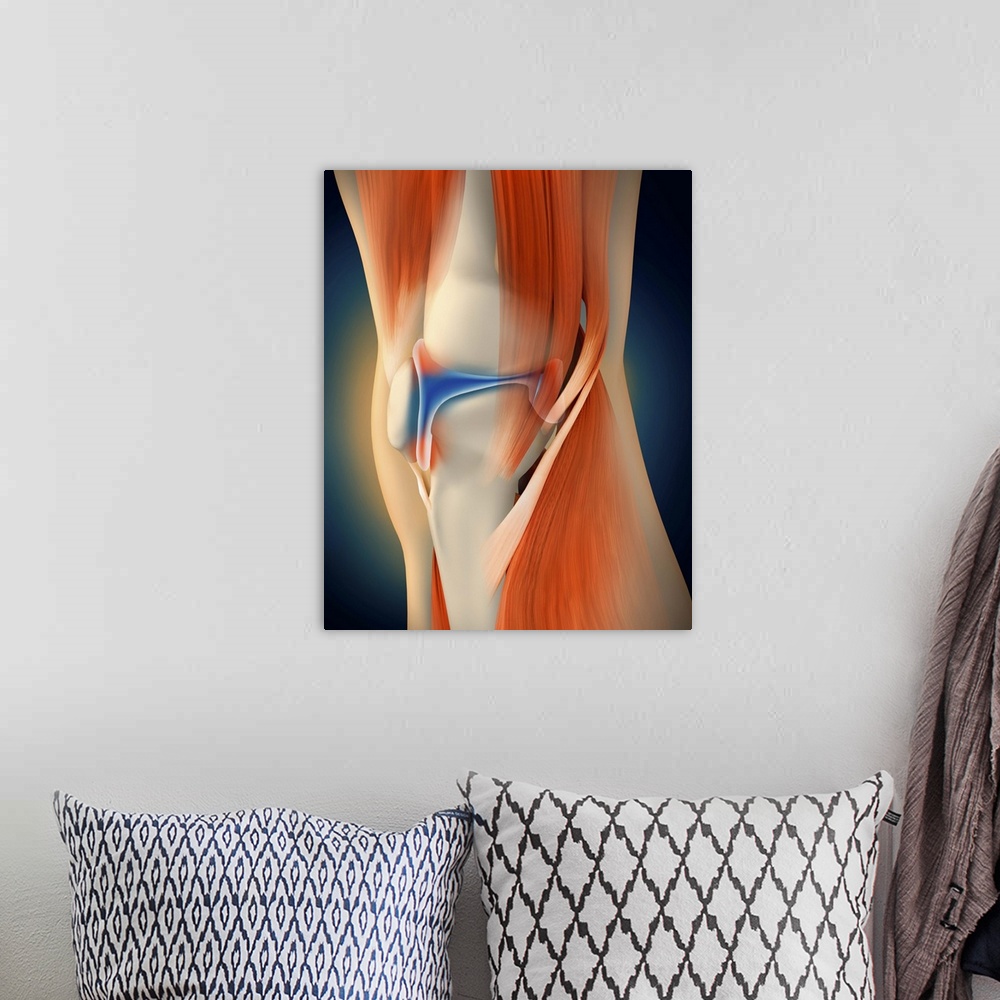 A bohemian room featuring Medical illustration showing inflammation and pain in human knee joint, perspective view.