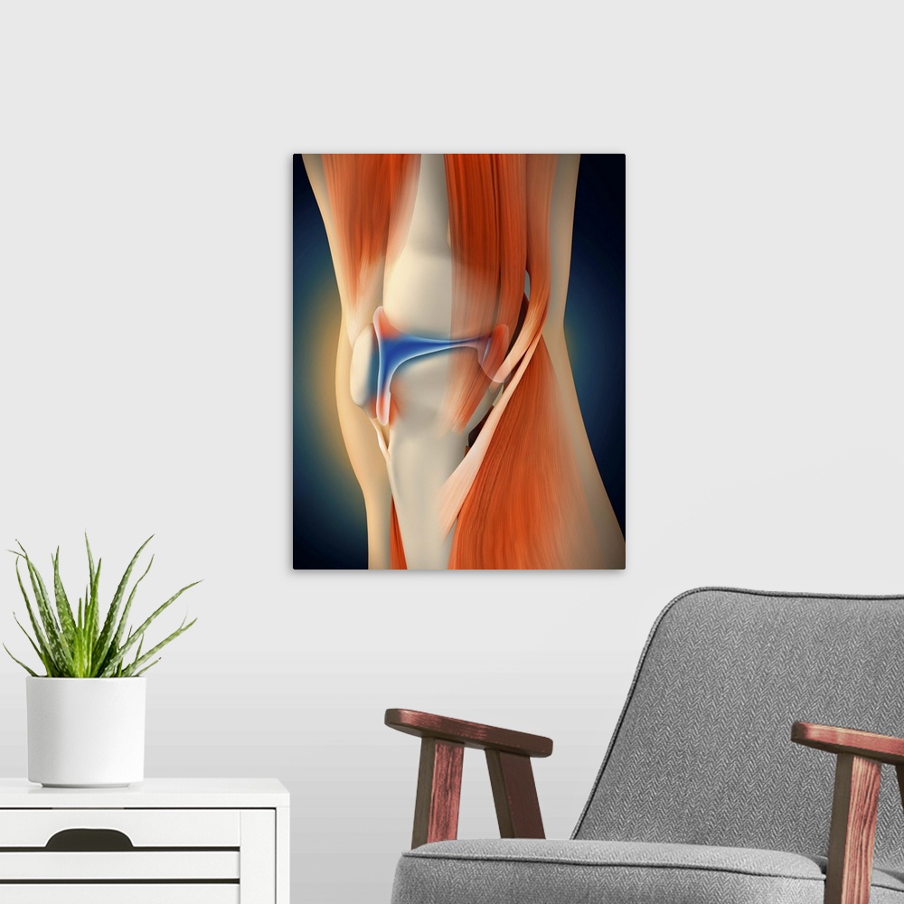 A modern room featuring Medical illustration showing inflammation and pain in human knee joint, perspective view.
