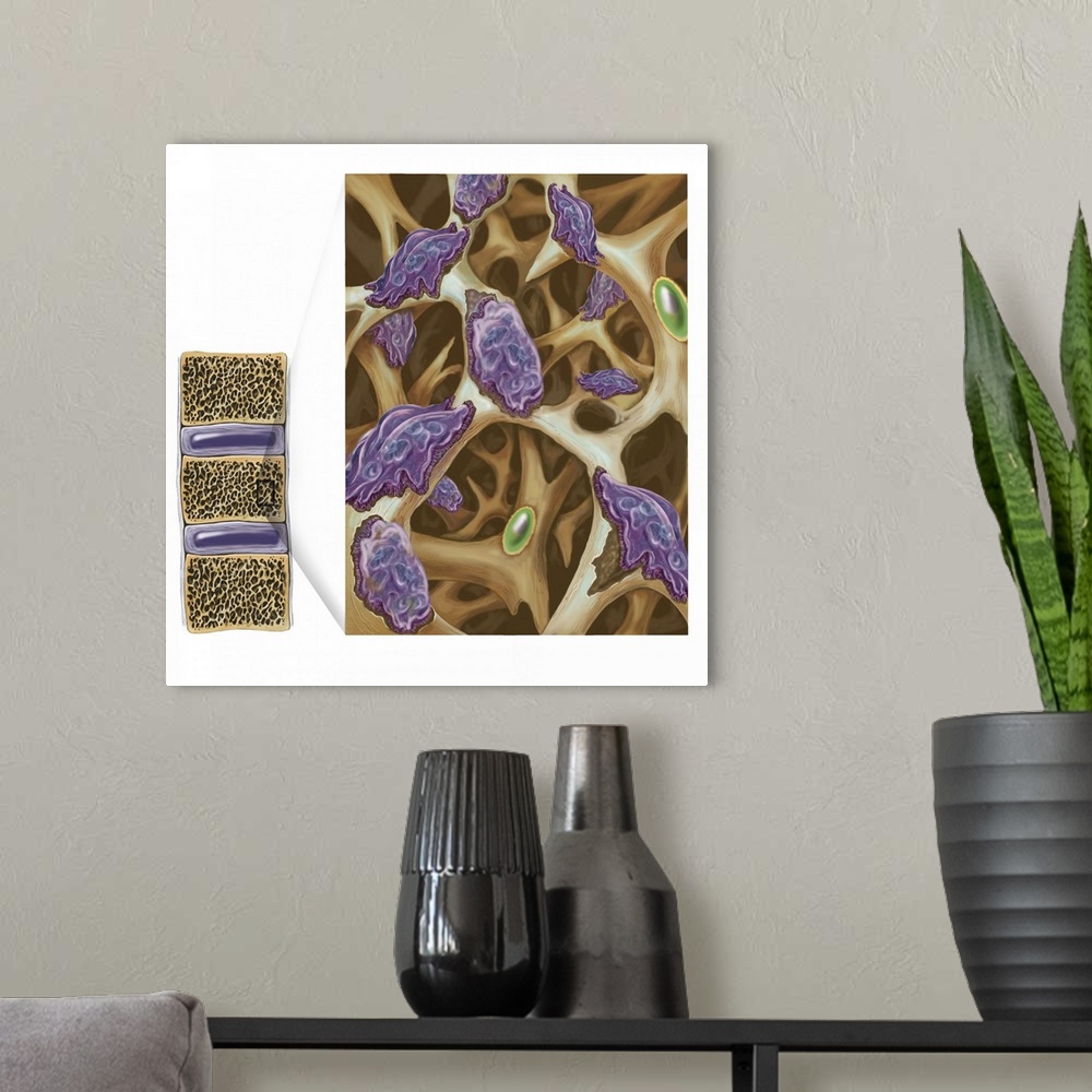 A modern room featuring Osteoclasts eroding bone in osteoporosis.