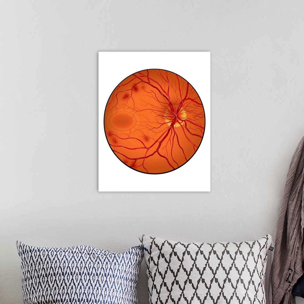 A bohemian room featuring Retina with neovascularization showing retinal hemorrhaging.