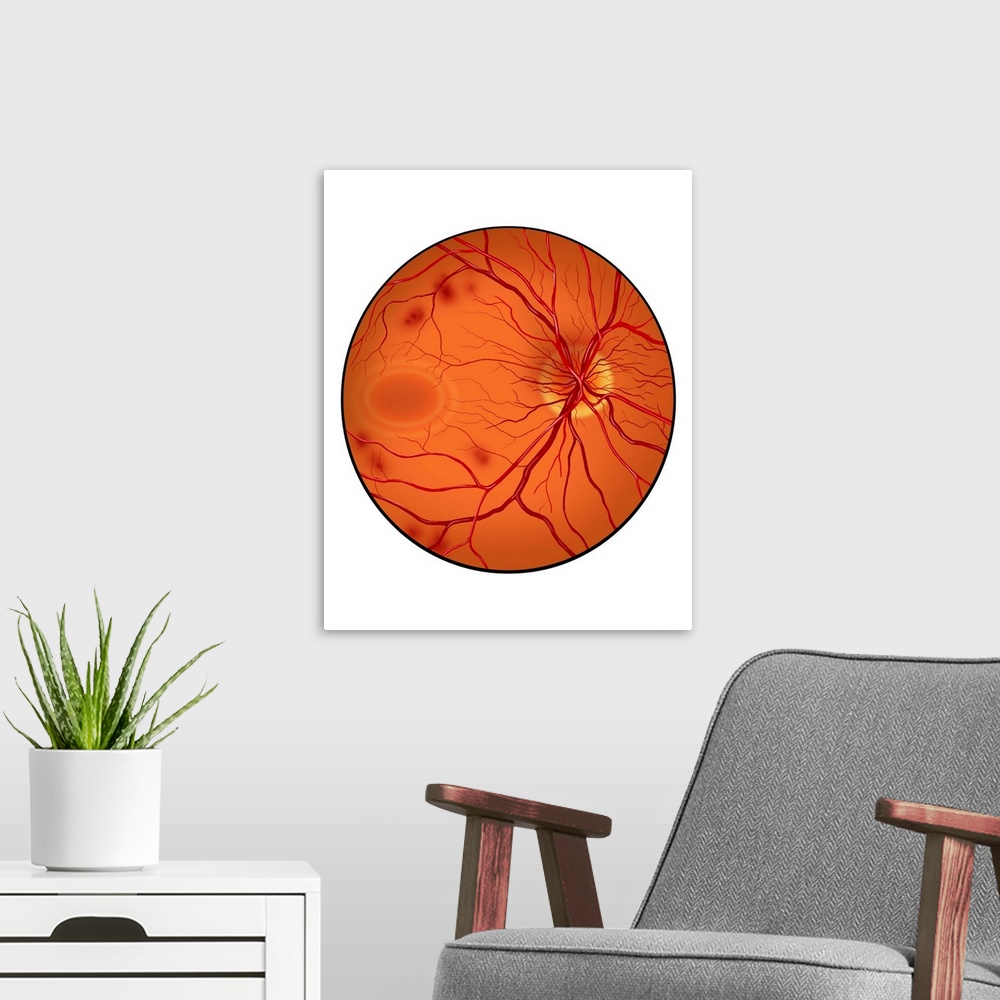 A modern room featuring Retina with neovascularization showing retinal hemorrhaging.