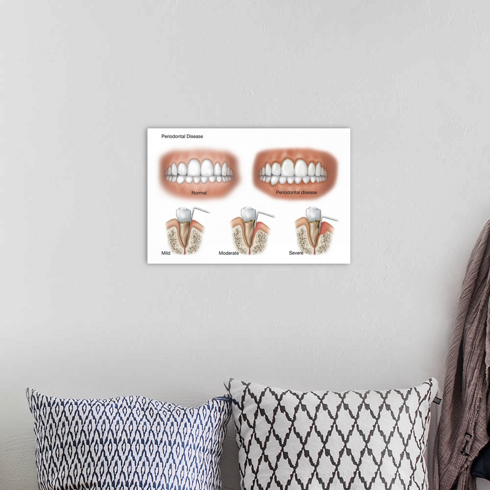 A bohemian room featuring Three stages of periodontal disease.