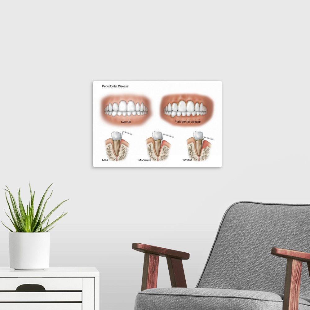 A modern room featuring Three stages of periodontal disease.